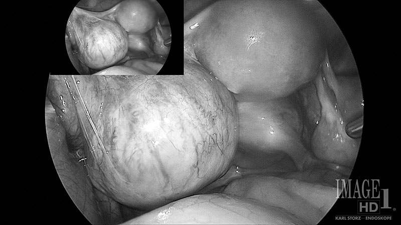 A black and white endoscopic image from Sumita Chakraborty's hysterectomy. A smaller version of the image is at the top left and overlaps the same, larger image.